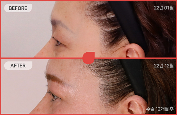 ด้านข้างของใบหน้า