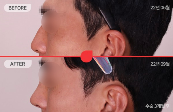 ด้านข้างของใบหน้า