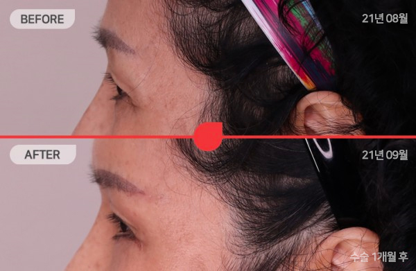 ด้านข้างของใบหน้า