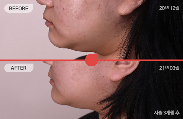 ด้านข้างของใบหน้า