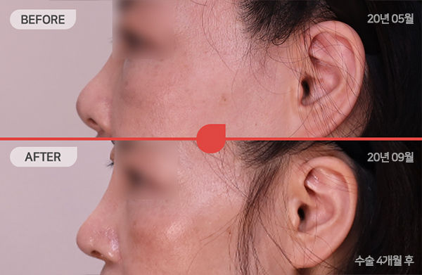 ด้านข้างของใบหน้า