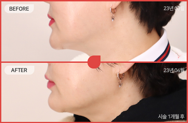 ด้านข้างของใบหน้า