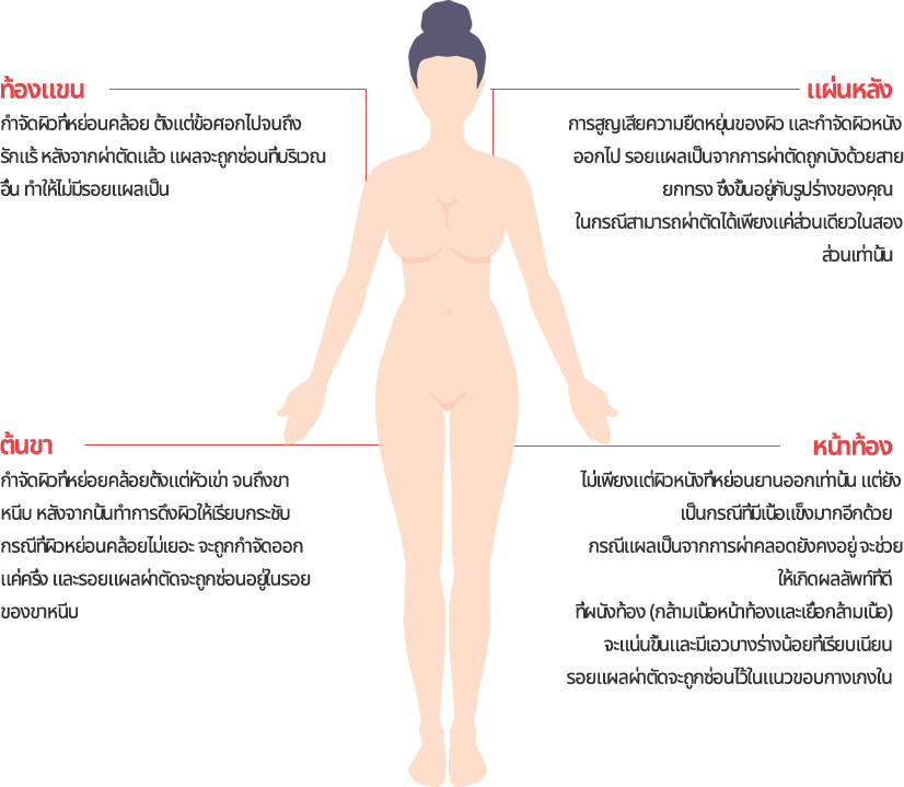 body_lift model img
