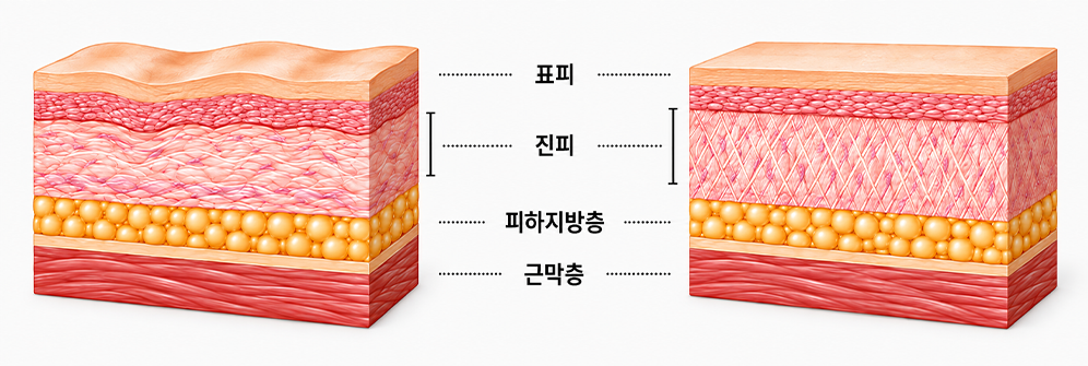 표피, 진피, 피하지방층과 근막층 구조 비교