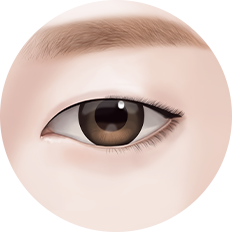 eye_incision_img01