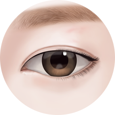 eye_incision_img14