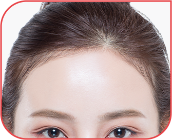 forehead_lift img