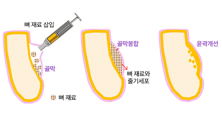 재생윤곽술 원리