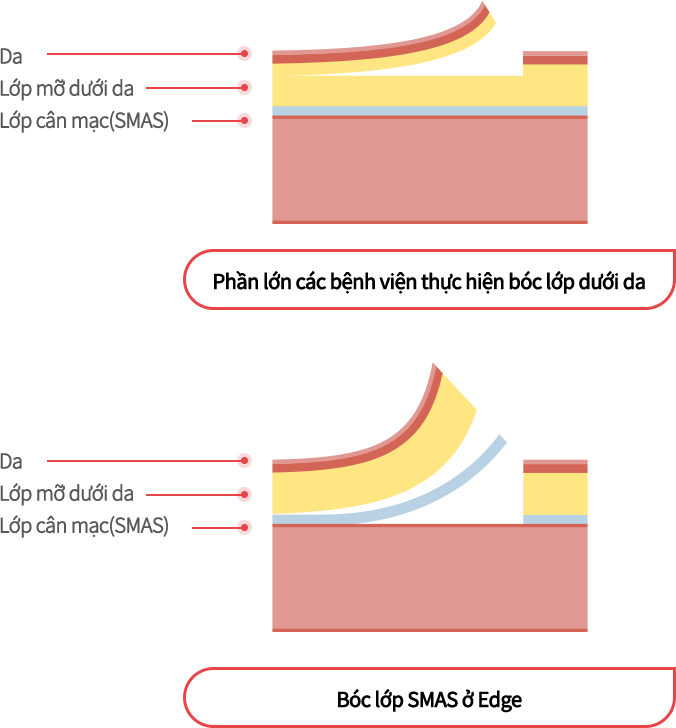 mini_incisio_img04_m