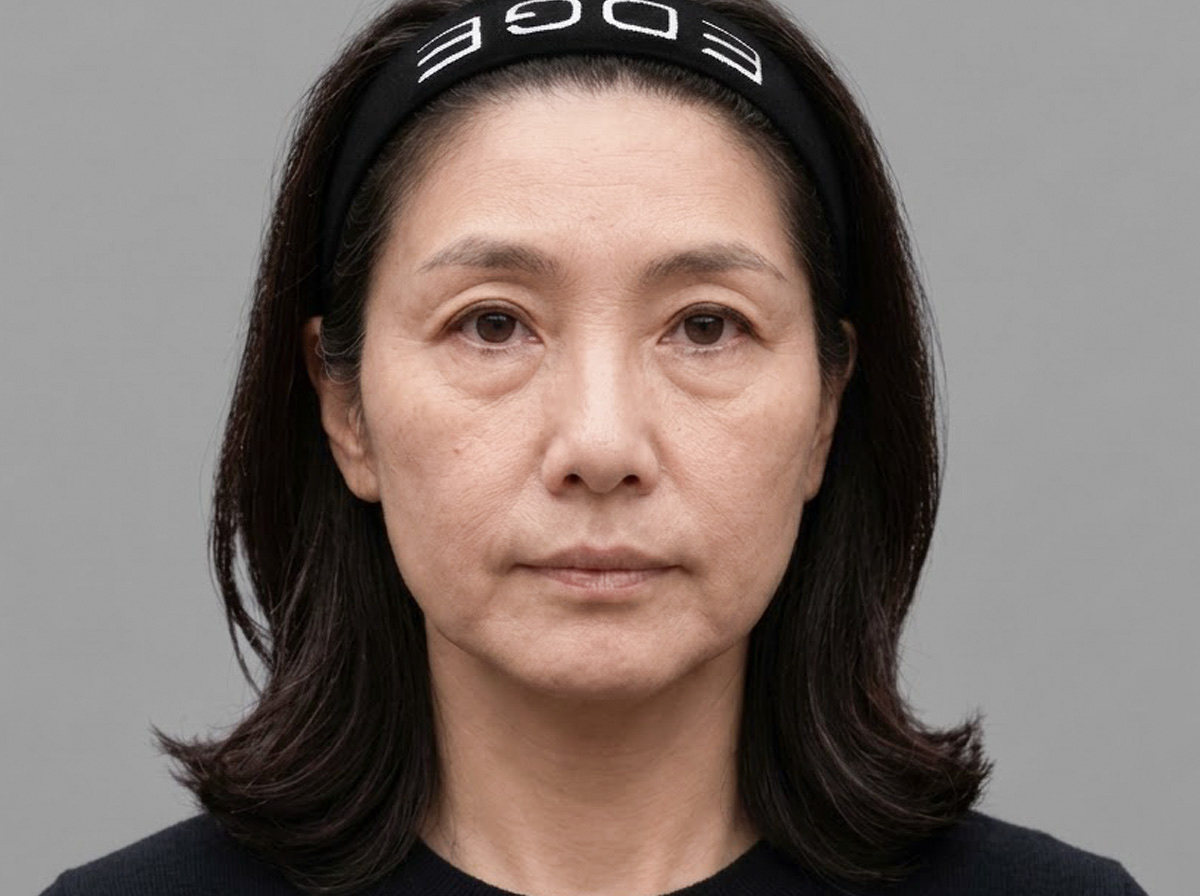 중년 눈성형 비교 이미지 전