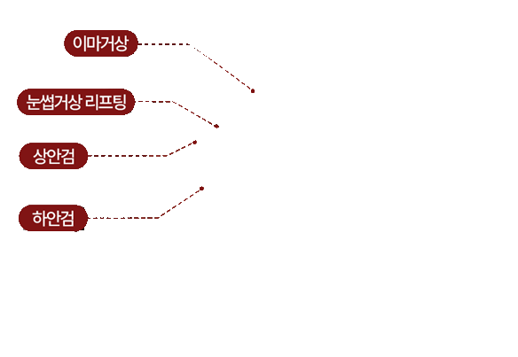이마거상, 눈썹거상 리프팅, 상안검, 하안검
